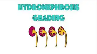 Bitesized radiology factoids: hydronephrosis grading | Radiology Nation