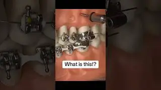 What are TADs for braces patients? #braces #bracestips #tads #orthodontics #dental #orthodontist