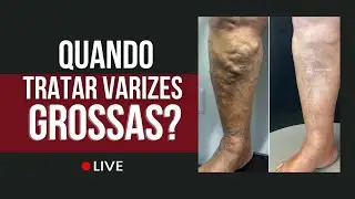 O que causa Varizes?