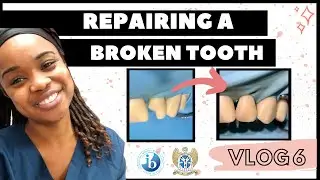HOW TO FIX A BROKEN TOOTH |  Anterior Composite Restoration |  DENTAL VLOG 6