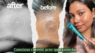 Conscious Chemist Acne Spot Corrector Review | 6 Hours Me Result? Honest Hindi Review||