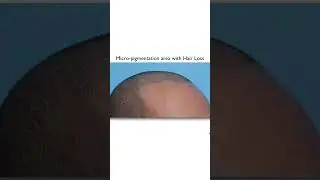 Scalp Micropigmentation Long-Term Results #scalpmicropigmentation