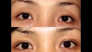 Before after Korean double eyelid surgery & ptosis correction at JW Plastic Surgery Clinic In Seoul
