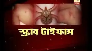 'Scrub Typhus' virus in Kolkata now