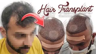Hair transplant in indore | Best Results & Cost of Hair Transplant in indore