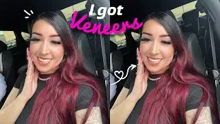 I GOT VENEERS!! W/ TrueSmile Veneers✨