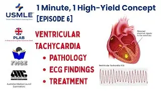 Ventricular Tachycardia in 1 Minute | USMLE Step 1 First Aid, PLAB, NBME | Causes, EKG, Treatment