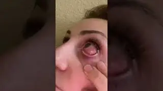 Can an eyelash cause eye infections? Yes! #beautiful eyes