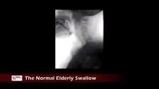 The Normal Elderly Swallow - Videofluoroscopic Review of Swallowing