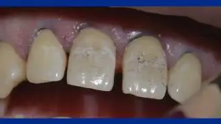 Fermeture de diastèmes au composite Dr David HACMOUN