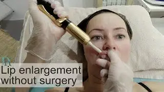lip enlargement without surgery in Richmond - part 1