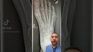 Toe fracture on x-ray 🦶