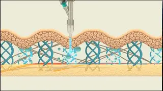 Transforming Medicine Through Science: Discover Needle-Free Injections