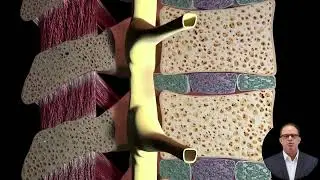 MILD&reg; Procedure for Lumbar Spinal Stenosis | South Florida Pain Doctor Explains