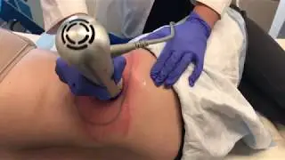 Coolsculpting Procedure Video at the Dermatology, Laser & Vein Center