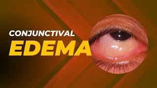 Conjunctival edema | Congestion in conjunctiva