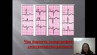 Arterial gipertoniya
