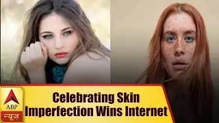 Campaign Celebrating Skin Imperfection Wins Internet | ABP News