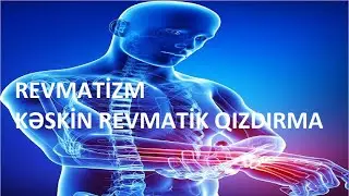 Revmatizm (kəskin revmatik qızdırma)