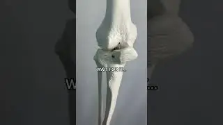 Bone Graft?