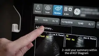 Introducing the eFAST Diagram on Venue&trade; Family POCUS