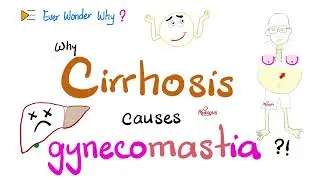 Why Cirrhosis causes Gynecomastia, Spider angiomata, Palmar erythema - Ever Wonder Why?
