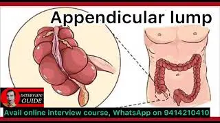 Appendicular lump | Army Doctor Interview | Ssc amc | CAPF interview | Interview Guide