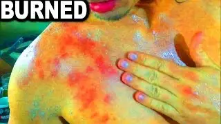 TRAMPOLINE STUNT GONE WRONG! 3rd Degree BURN | JOOGSQUAD PPJT