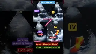 DCMP Echo l Congestive heart failure echo l Dilated Heart l हार्ट फेलियर इको #shorts