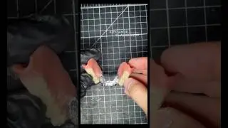 Interest Bite Case: Partial Denture + Full Upper Denture #partialdenture  #removabledentures