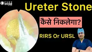 URSL vs RIRS Which one is better in ut stone removal? | पथरी हटाने में कौन सी  प्रक्रिया बेहतर है?