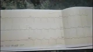Anterio septal MI ,tachycardia