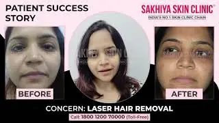 Top Laser Hair Removal Results | Real Patient Experience | Sakhiya Skin Clinic Pune