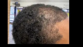 MONTH 4 | Hair Transplant | Asli Tarcan | FUE | 5250 GRAFTS | Turkey Istanbul 🇹🇷