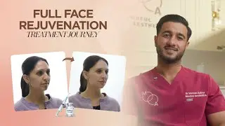 10ML Natural Dermal Filler Full Face Rejuvenation | Annie&rsquo;s Treatment Journey