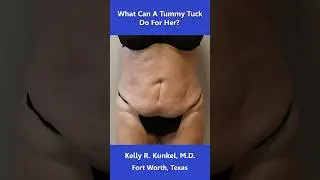 Tummy Tuck with Liposuction in a Patient with Previous Colon Surgery: See Her Result
