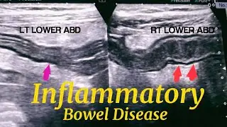 Inflammatory Bowel Disease on Ultrasound | Crohn's Disease | Ulcerative Colitis | HINDI | URDU