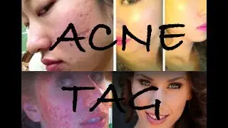 Acne Tag (& Conversation!) With Daisy From PerfectBeauty!