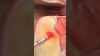 How laser fistula repair is done? #lasersurgery #fistularepair #laser
