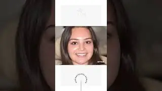 Our latest Beverly Hills smile makeover #Shorts
