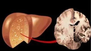 Fatty liver starves brain of an essential protein, leading to dementia