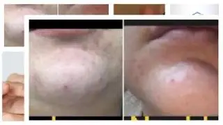 Hanf Feuchtigkeitscreme unreine Haut &ndash; Cannabis Gesichtspflege bei Akne &ndash; Gesichtscreme gegen Pickel