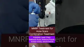 MNRF Treatment for Acne Scars Combination Treatment | Face Scars | Results