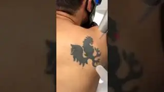 Laser tattoo Removal || How to remove tattoo