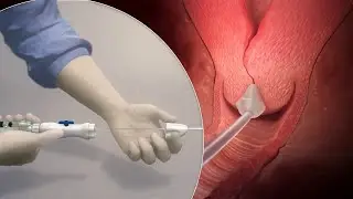 Definity  Cervical Dilator Product Animation