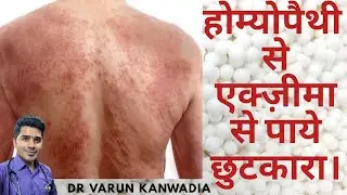 5 BEST HOMEOPATHY MEDICINES FOR ECZEMA ll ATOPIC DERMATITIS (खुजली)