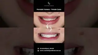 Porcelain Veneers ~ Female Patient Cases #dental #veneers #dentalveneers