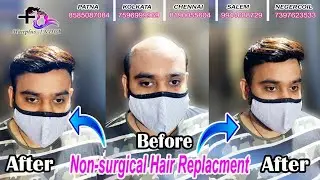 Hair Bonding | Hair Wig | Baldness Solution | Natural Hair Solution For Baldness | Hair Replacement