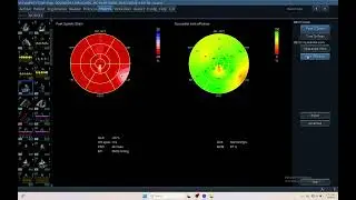 IQ 693 RV GWE MYOCARDIAL WORK EFFICIENCY RVEF RVGLS RVPSD RVTTP RVPSI ECHOCARDIOGRAPHY