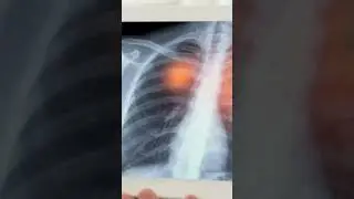 COPD Symptoms, Treatment,Home remedies